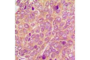 Immunohistochemical analysis of SYK staining in human breast cancer formalin fixed paraffin embedded tissue section. (SYK antibody  (Center))