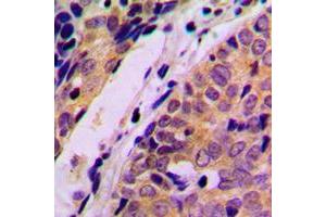 Immunohistochemical analysis of HARS staining in human breast cancer formalin fixed paraffin embedded tissue section. (HARS1/Jo-1 antibody  (C-Term))