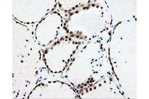 Immunohistochemical staining of paraffin-embedded Adenocarcinoma of breast tissue using anti-HDHD2 mouse monoclonal antibody. (HDHD2 antibody)