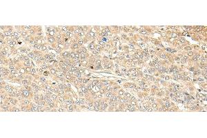 Immunohistochemistry of paraffin-embedded Human liver cancer tissue using WDFY4 Polyclonal Antibody at dilution of 1:50(x200) (WDFY4 antibody)