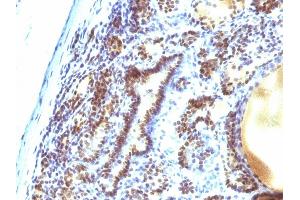 Formalin-fixed, paraffin-embedded human Thyroid Carcinoma stained with MAP3K1 Mouse Monoclonal Antibody (2F6). (MAP3K1 antibody  (AA 1077-1176))