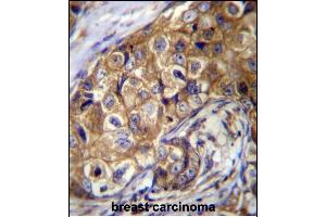 CTAGE5 Antibody (C-term) (ABIN656676 and ABIN2845915) immunohistochemistry analysis in formalin fixed and paraffin embedded human breast carcinoma followed by peroxidase conjugation of the secondary antibody and DAB staining. (MIA2 antibody  (C-Term))