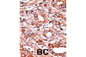 Formalin-fixed and paraffin-embedded human cancer tissue reacted with ABL1 (phospho Y134) polyclonal antibody  which was peroxidase-conjugated to the secondary antibody followed by AEC staining. (ABL1 antibody  (pTyr134))