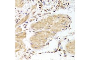 Immunohistochemistry of paraffin-embedded Human gastric cancer using CASP2 antibody at dilution of 1:100 (x400 lens).
