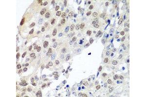 Immunohistochemistry of paraffin-embedded Human lung cancer using PTTG1 Polyclonal Antibody at dilution of 1:100 (40x lens). (PTTG1 antibody)