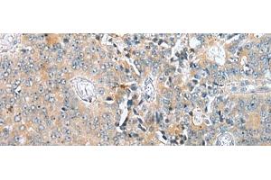 Immunohistochemistry of paraffin-embedded Human prost at e cancer tissue using COMMD6 Polyclonal Antibody at dilution of 1:45(x200)