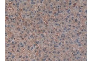 Detection of HBb in Human Liver cancer Tissue using Polyclonal Antibody to Hemoglobin Beta (HBb) (Hemoglobin Subunit beta antibody  (AA 1-147))