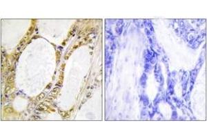 Immunohistochemistry analysis of paraffin-embedded human colon carcinoma tissue, using IRF2 Antibody. (IRF2 antibody  (AA 101-150))