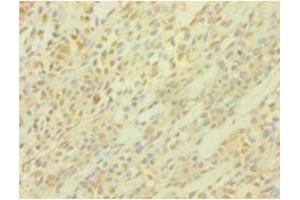 Immunohistochemistry of paraffin-embedded human breast cancer using ABIN7164283 at dilution of 1:100 (PICK1 antibody  (AA 1-200))