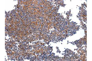 Immunohistochemistry of Human ovarian cancer using HSPD1 Polyclonal Antibody at dilution of 1:30 (HSPD1 antibody)