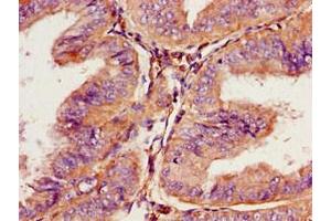 Immunohistochemistry of paraffin-embedded human endometrial cancer using ABIN7164713 at dilution of 1:100 (Prokineticin Receptor 2 antibody  (AA 1-45))