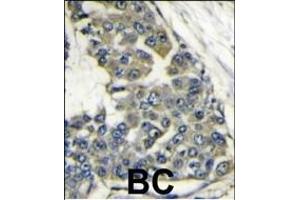 Formalin-fixed and paraffin-embedded human breast carcinoma reacted with EIF4B antibody (Center) (ABIN388669 and ABIN2837872) , which was peroxidase-conjugated to the secondary antibody, followed by DAB staining. (EIF4B antibody  (AA 353-382))