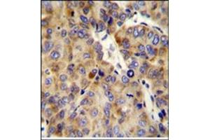 Formalin fixed and paraffin embedded human hepatocarcinoma stained with COL18A1 Antibody (Center) Cat. (COL18A1 antibody  (Chain alpha 1, Middle Region))