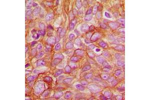 Immunohistochemical analysis of PKC delta (pT507) staining in human breast cancer formalin fixed paraffin embedded tissue section.