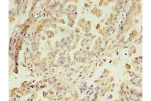 Immunohistochemistry of paraffin-embedded human lung cancer using ABIN7144550 at dilution of 1:100 (GIT2 antibody  (AA 1-603))