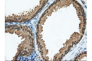 Immunohistochemical staining of paraffin-embedded Adenocarcinoma of Human ovary tissue using anti-ACAT2 mouse monoclonal antibody. (ACAT2 antibody)