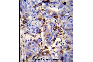 GCDFP-15 Antibody (C-term) (ABIN655074 and ABIN2844706) immunohistochemistry analysis in formalin fixed and paraffin embedded human breast carcinoma followed by peroxidase conjugation of the secondary antibody and DAB staining.