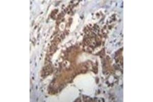 Immunohistochemistry analysis in formalin fixed and paraffin embedded human colon carcinoma reacted with PCYT1A Antibody (N-term) followed by peroxidase conjugation of the secondary antibody and DAB staining. (PCYT1A antibody  (N-Term))