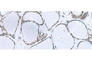 Immunohistochemistry of paraffin-embedded Human thyroid cancer tissue using POMC Polyclonal Antibody at dilution of 1:35(x200) (POMC antibody)
