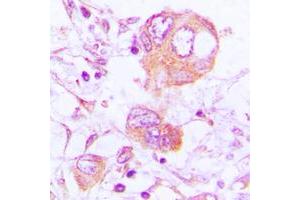 Immunohistochemical analysis of Cathepsin H staining in human lung cancer formalin fixed paraffin embedded tissue section. (Cathepsin H antibody  (Center))