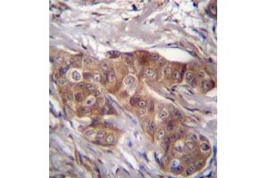 Immunohistochemistry analysis in formalin fixed and paraffin embedded human breast carcinoma using LPAR6 Antibody (Center) followed which was peroxidase conjugated to the secondary antibody and followed by DAB staining. (LPAR6 antibody  (Middle Region))