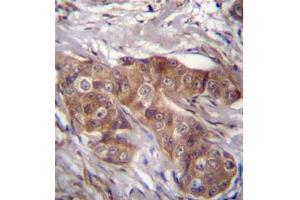 Immunohistochemistry analysis in formalin fixed and paraffin embedded human breast carcinoma using LPAR6 Antibody (Center) followed which was peroxidase conjugated to the secondary antibody and followed by DAB staining.