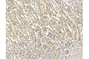 ABIN6263325 and ABIN6279013 at 1/100 staining human colorectal cancer and adjacent non-tumor tissue by IHC-P.