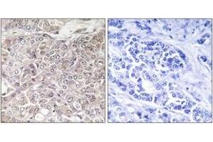 Immunohistochemistry analysis of paraffin-embedded human breast carcinoma, using GPRIN3 Antibody. (GPRIN3 antibody  (AA 131-180))