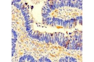 Immunohistochemistry of paraffin-embedded human ovarian cancer using ABIN7148136 at dilution of 1:100 (CCDC66 antibody  (AA 87-286))