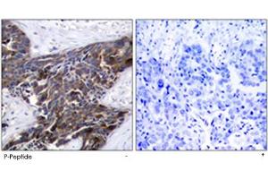 Immunohistochemical analysis of paraffin-embedded human breast carcinoma tissue using GJA1 (phospho S367) polyclonal antibody . (Connexin 43/GJA1 antibody  (pSer367))