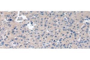 Immunohistochemistry of paraffin-embedded Human liver cancer using RAB2A Polyclonal Antibody at dilution of 1/40 (RAB2A antibody)
