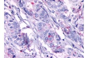 Immunohistochemical staining of Colon carcinoma (Neoplastic cells) using anti- GPR124 antibody ABIN122437