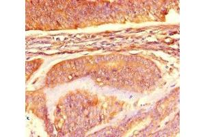 Immunohistochemistry of paraffin-embedded human endometrial cancer using ABIN7160847 at dilution of 1:100 (NAD-ME antibody  (AA 296-424))