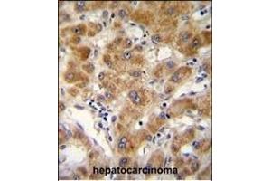 ODF3B antibody (N-term) (ABIN654768 and ABIN2844448) immunohistochemistry analysis in formalin fixed and paraffin embedded human hepatocarcinoma followed by peroxidase conjugation of the secondary antibody and DAB staining. (ODF3B antibody  (N-Term))