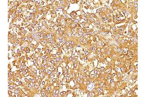 Formalin-fixed, paraffin-embedded human Melanoma stained with gp100 / Melanosome Monoclonal Antibody (SPM142).