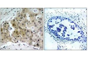 Immunohistochemical analysis of paraffin-embedded human breast carcinoma tissue using VEGFR2(Phospho-Tyr1175) Antibody(left) or the same antibody preincubated with blocking peptide(right). (VEGFR2/CD309 antibody  (pTyr1175))