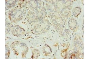 Immunohistochemistry of paraffin-embedded human breast cancer using ABIN7173225 at dilution of 1:100 (TMEM45A antibody  (AA 171-217))