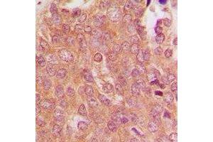 Immunohistochemical analysis of MID1 staining in human breast cancer formalin fixed paraffin embedded tissue section. (MID1 antibody  (N-Term))