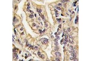 IHC analysis of FFPE human lung carcinoma tissue stained with CSF1R antibody (CSF1R antibody  (AA 940-971))