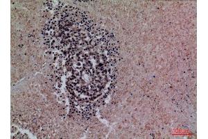 Immunohistochemistry (IHC) analysis of paraffin-embedded Human Lung Cancer, antibody was diluted at 1:100. (Surfactant Protein A1 antibody  (Internal Region))