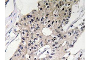 Immunohistochemical analysis of paraffin-embedded human breast cancer tissue using DEFA1 polyclonal antibody . (alpha Defensin 1 antibody)