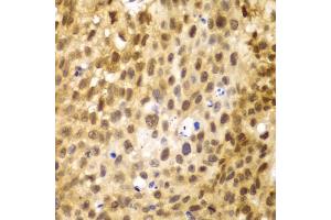 Immunohistochemistry of paraffin-embedded human lung cancer using IRF3 antibody (ABIN5998002) at dilution of 1/100 (40x lens). (IRF3 antibody)