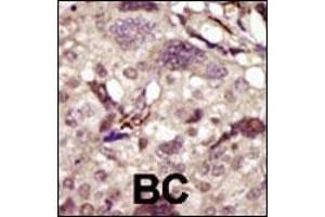Formalin-fixed and paraffin-embedded human cancer tissue reacted with the primary antibody, which was peroxidase-conjugated to the secondary antibody, followed by DAB staining. (BTK antibody  (AA 209-239))