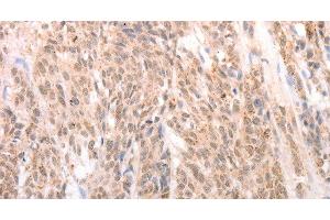 Immunohistochemistry of paraffin-embedded Human liver cancer tissue using ACIN1 Polyclonal Antibody at dilution 1:80 (ACIN1 antibody)