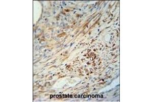 KIF9 antibody (C-term) (ABIN652134 and ABIN2840560) immunohistochemistry analysis in formalin fixed and paraffin embedded human prostate carcinoma followed by peroxidase conjugation of the secondary antibody and DAB staining. (KIF9 antibody  (C-Term))