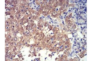 Immunohistochemical analysis of paraffin-embedded endometrial cancer tissues using PRDM4 mouse mAb with DAB staining.