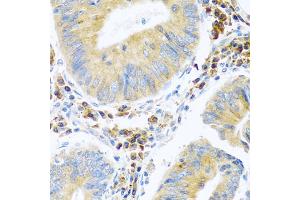Immunohistochemistry of paraffin-embedded human colon carcinoma using MANF antibody. (MANF antibody)