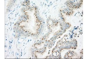 Immunohistochemical staining of paraffin-embedded Adenocarcinoma of Human colon tissue using anti-IFT57 mouse monoclonal antibody. (IFT57 antibody)