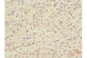Immunohistochemistry of paraffin-embedded human liver cancer using ABIN7157914 at dilution of 1:100 (LSS antibody  (AA 1-300))
