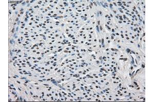 Immunohistochemical staining of paraffin-embedded Carcinoma of thyroid tissue using anti-FKBP5mouse monoclonal antibody.